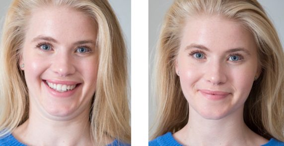 A before and after shot of a woman with a large smile and double chin and more reserved smile that doesn't seem as open
